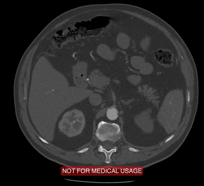 File:Acute aortic dissection - Stanford type A (Radiopaedia 40661-43285 Axial C+ arterial phase 95).jpg