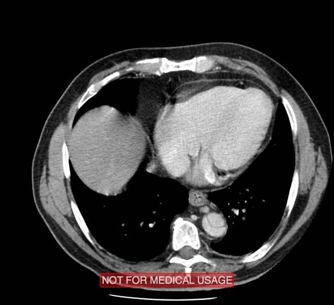 File:Acute aortic dissection - Stanford type A (Radiopaedia 40661-43285 Axial C+ portal venous phase 43).jpg