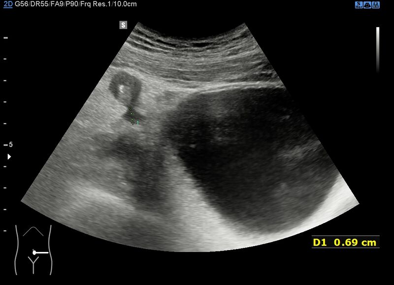 File:Acute appendicitis (Radiopaedia 85193-100745 Oblique 3).jpg