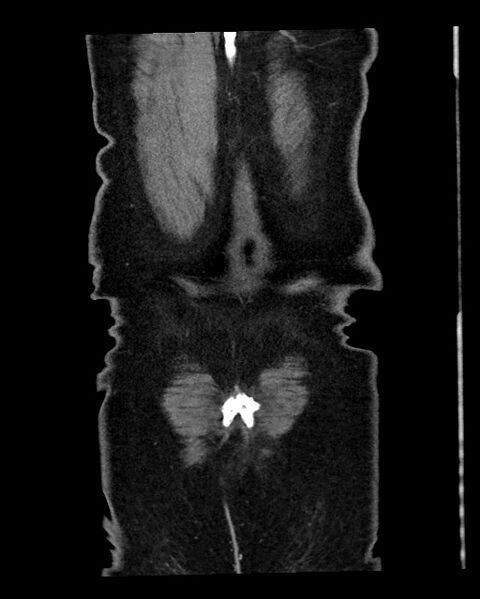 File:Acute appendicitis - large appendicoliths (Radiopaedia 61805-69820 Coronal C+ portal venous phase 128).jpg