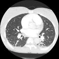 Acute chest syndrome - sickle cell disease (Radiopaedia 42375-45499 Axial lung window 98).jpg