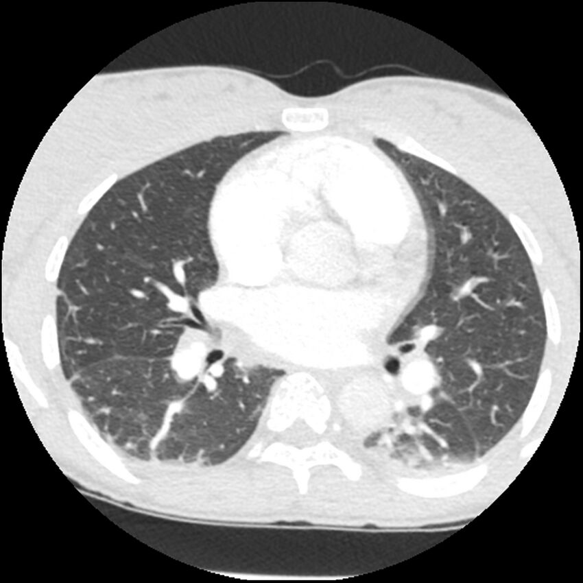 Acute chest syndrome - sickle cell disease (Radiopaedia 42375-45499 Axial lung window 98).jpg