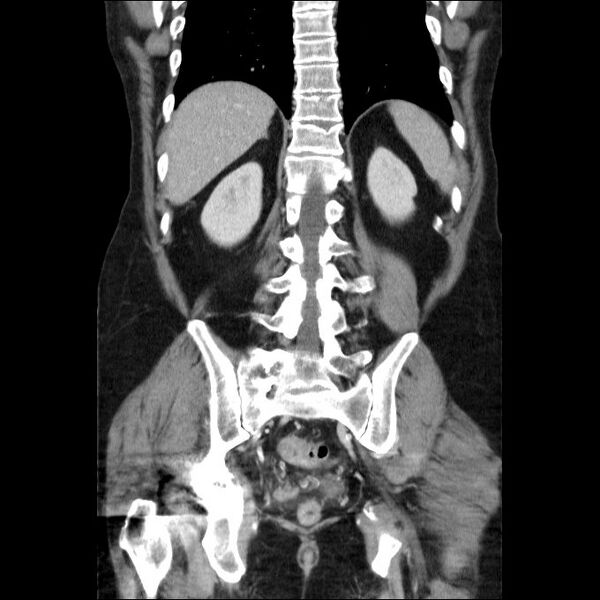 File:Acute cholecystitis and incidental left sided IVC (Radiopaedia 49352-54459 Coronal C+ portal venous phase 22).jpg