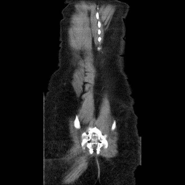 File:Acute cholecystitis and incidental left sided IVC (Radiopaedia 49352-54459 Coronal C+ portal venous phase 8).jpg
