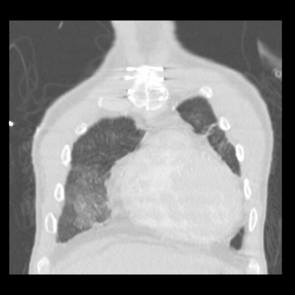 File:Acute diffuse alveolar hemorrhage (Radiopaedia 41323-44158 Coronal lung window 4).jpg