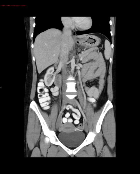 File:Acute gastritis (Radiopaedia 21043-20975 Coronal C+ portal venous phase 13).jpg