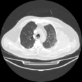 Acute heart failure (CT) (Radiopaedia 79835-93075 Axial lung window 14).png