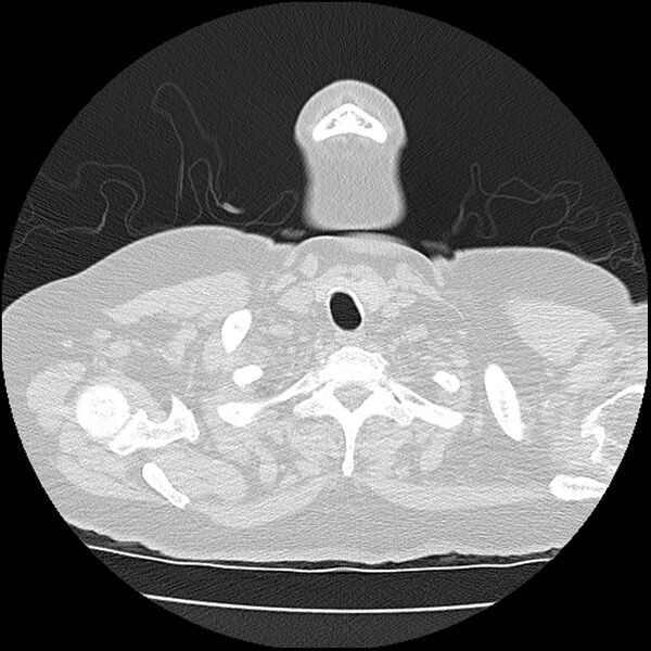 File:Acute interstitial pneumonitis (Radiopaedia 45404-49452 Axial lung window 1).jpg