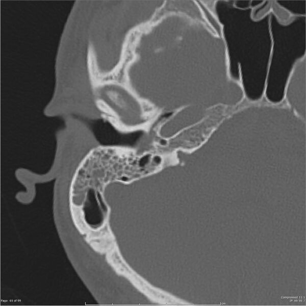 File:Acute otomastoiditis (Radiopaedia 28276-28512 Axial PTB bone window reformat 45).jpg