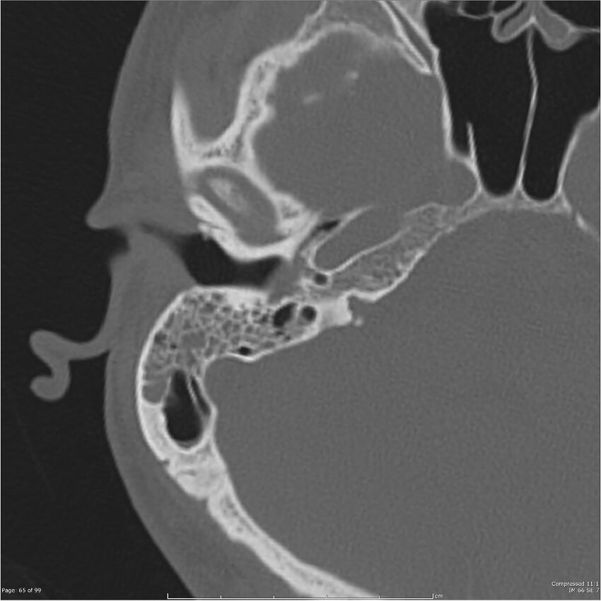 Acute otomastoiditis (Radiopaedia 28276-28512 Axial PTB bone window reformat 45).jpg