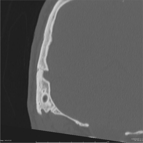 File:Acute otomastoiditis (Radiopaedia 28276-28512 Coronal PTB bone window reformat 76).jpg