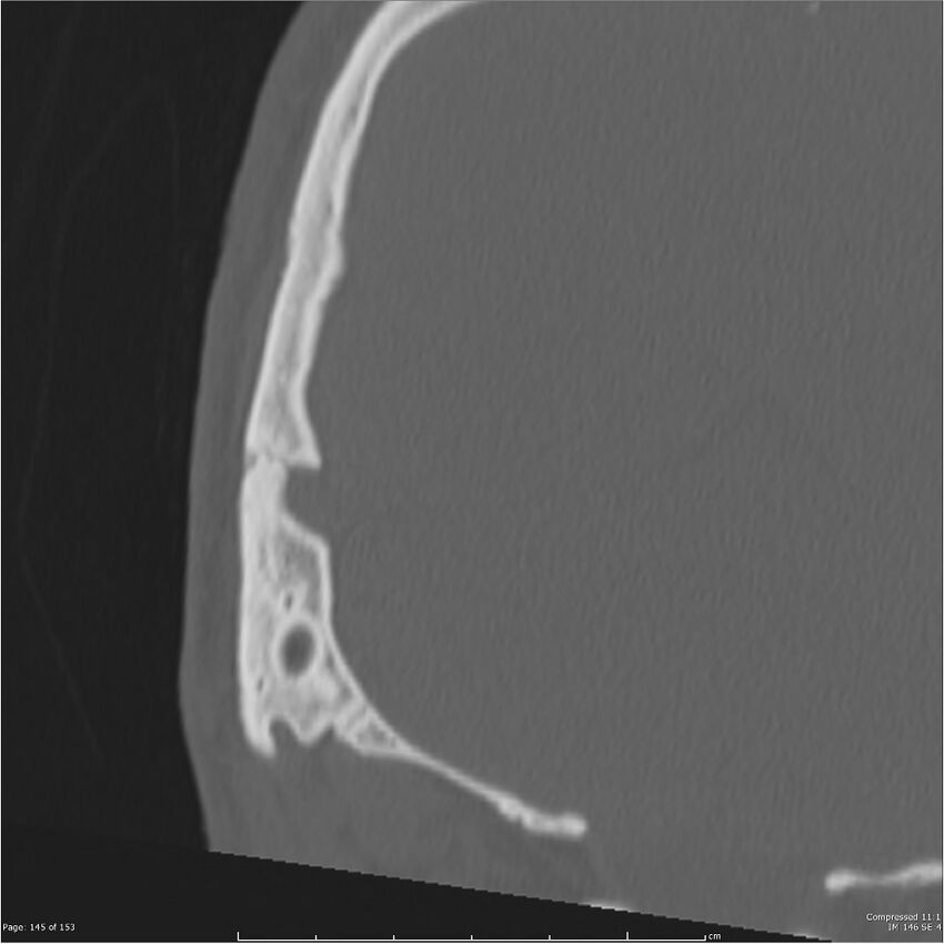Acute otomastoiditis (Radiopaedia 28276-28512 Coronal PTB bone window reformat 76).jpg