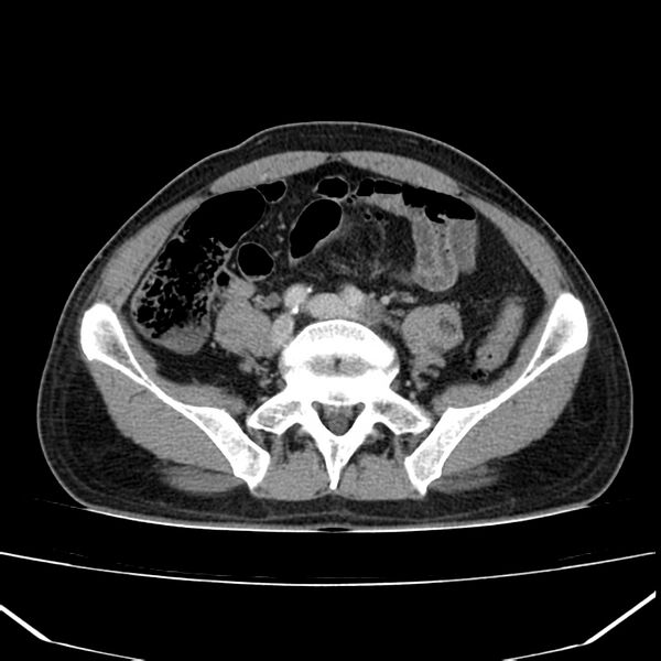 File:Acute pancreatitis (Radiopaedia 22572-22596 Axial C+ portal venous phase 51).jpg