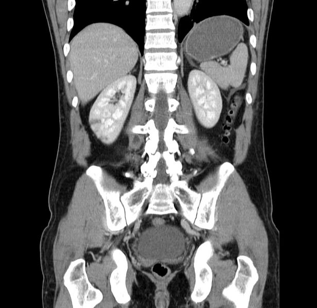 File:Acute pancreatitis (Radiopaedia 22572-22596 Coronal C+ portal venous phase 39).jpg