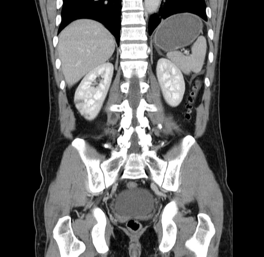 Acute pancreatitis (Radiopaedia 22572-22596 Coronal C+ portal venous phase 39).jpg