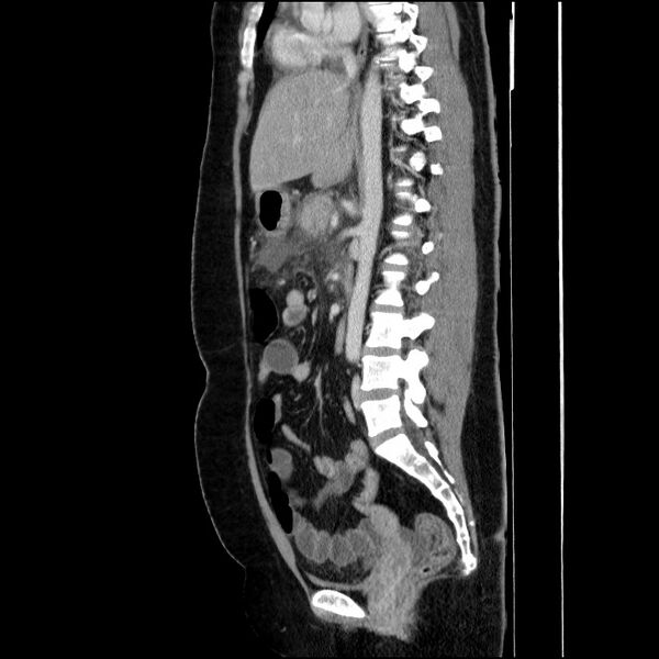 File:Acute pancreatitis (Radiopaedia 69236-79012 Sagittal C+ portal venous phase 51).jpg