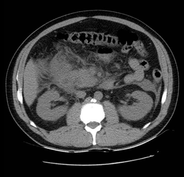 File:Acute pancreatitis - Balthazar E (Radiopaedia 23080-23110 Axial non-contrast 30).jpg