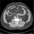 Acute pancreatitis - mild (Radiopaedia 27796-28033 C+ portal venous phase 33).jpg