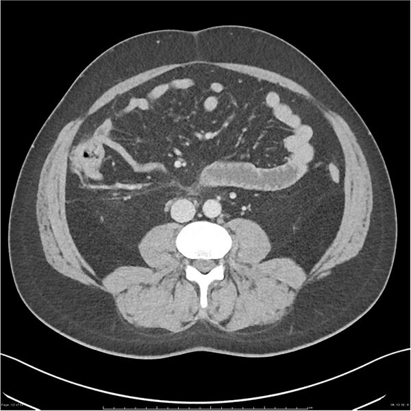 File:Acute pancreatitis - mild (Radiopaedia 27796-28033 C+ portal venous phase 33).jpg