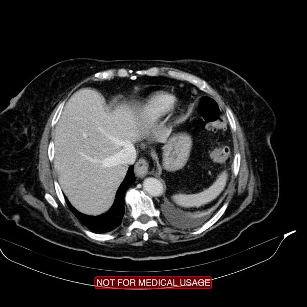 File:Acute pancreatitis with infected necrosis (Radiopaedia 26454-26585 Axial C+ portal venous phase 1).jpg