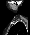 Acute parotitis (Radiopaedia 27425-27619 Sagittal C+ portal venous phase 49).png