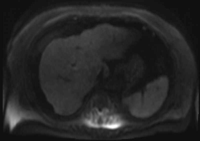 File:Acute portal vein thrombosis (Radiopaedia 73198-83925 Axial DWI 41).jpg