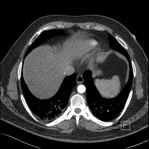 File:Acute pulmonary embolism with pulmonary infarct (Radiopaedia 73062-83768 Axial C+ CTPA 61).jpg
