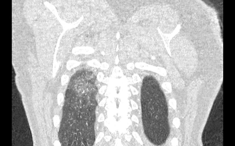 File:Acute pulmonary embolism with pulmonary infarcts (Radiopaedia 77688-89908 Coronal lung window 97).jpg