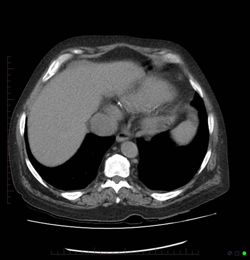 Acute renal failure post IV contrast injection- CT findings (Radiopaedia 47815-52557 Axial non-contrast 10).jpg