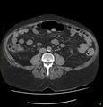 Acute renal failure post IV contrast injection- CT findings (Radiopaedia 47815-52557 Axial non-contrast 47).jpg