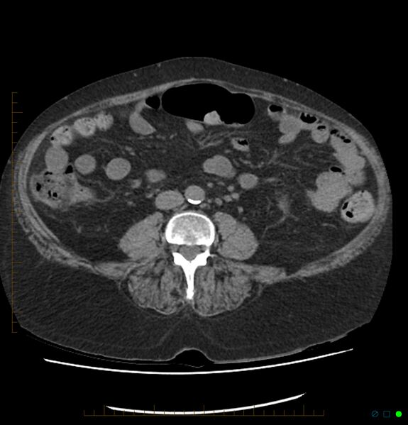 File:Acute renal failure post IV contrast injection- CT findings (Radiopaedia 47815-52557 Axial non-contrast 47).jpg