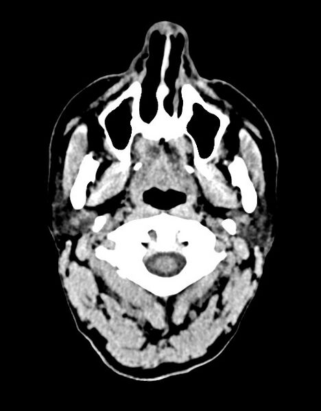 File:Acute superior cerebellar artery territory infarct (Radiopaedia 84104-99359 Axial non-contrast 68).jpg