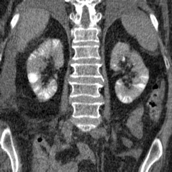 File:Acute tubular necrosis (Radiopaedia 28077-28334 Coronal non-contrast 18).jpg