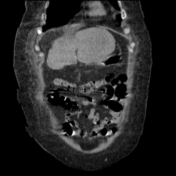 File:Acute tubular necrosis (Radiopaedia 28077-28334 D 21).jpg