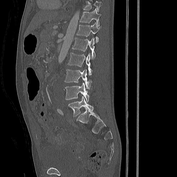File:Acute vertebral body compression fractures (Radiopaedia 31757-32693 Sagittal bone window 18).jpg