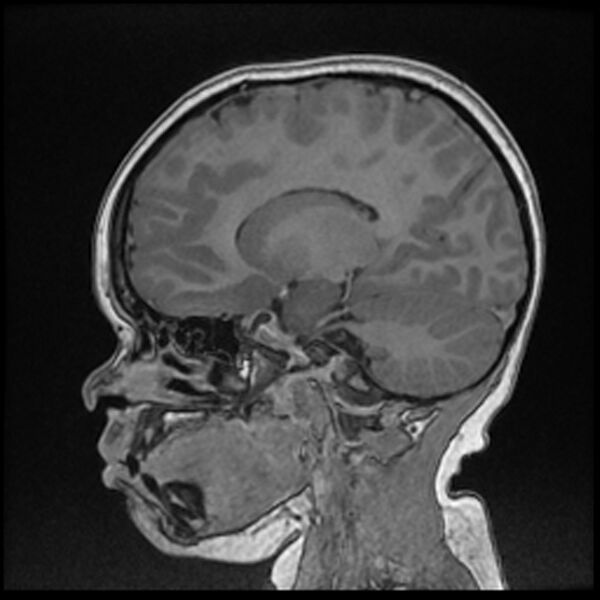File:Adamantinomatous craniopharyngioma (Radiopaedia 77407-89529 Sagittal T1 C+ 54).jpg