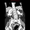 Adenocarcinoma of the colon (Radiopaedia 8191-9039 Coronal liver window 32).jpg