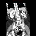 Adenocarcinoma of the colon (Radiopaedia 8191-9039 Coronal liver window 34).jpg