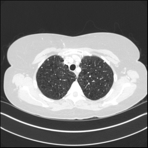 File:Adenocarcinoma of the lung (Radiopaedia 44205-47803 Axial lung window 23).jpg