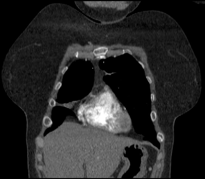 File:Adenocarcinoma of the lung (Radiopaedia 44205-47803 Coronal C+ portal venous phase 16).jpg