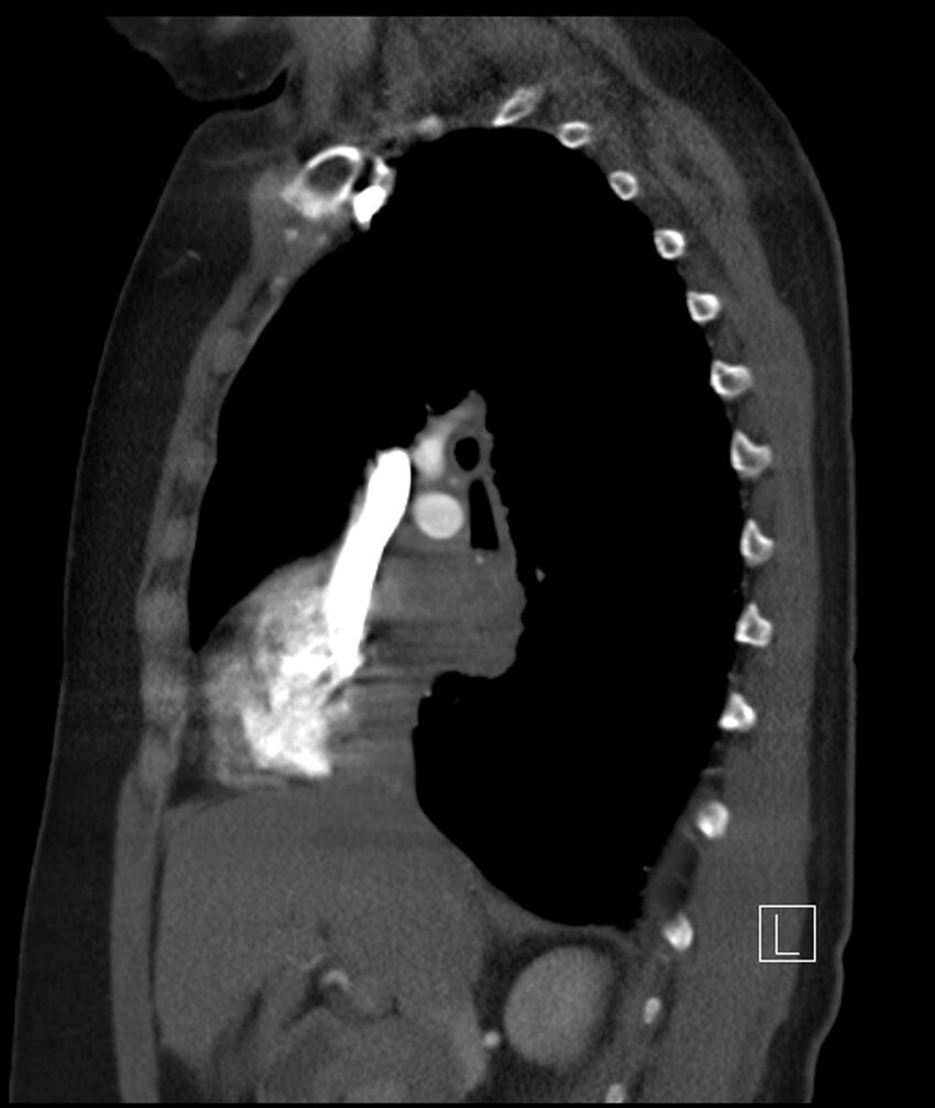 Adenocarcinoma of the lung (Radiopaedia 44205-47803 Sagittal C+ portal venous phase 34).jpg