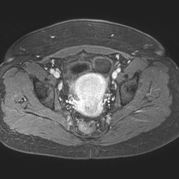 File:Adenomyoma of the uterus (Radiopaedia 9871-10439 Axial T1 C+ fat sat 11).jpg