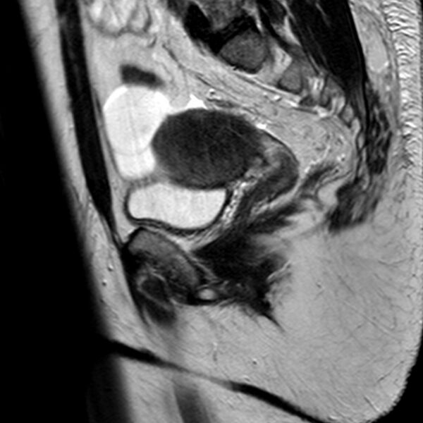 File:Adenomyoma of the uterus (Radiopaedia 9871-10439 Sagittal T2 10).jpg