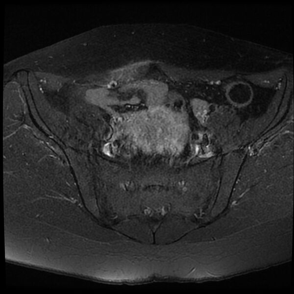 File:Adenomyosis-scar endometriosis (Radiopaedia 65863-75022 Axial T1 C+ fat sat 5).jpg