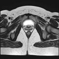 Adenomyosis - ovarian endometriomas (Radiopaedia 67031-76350 Axial T2 24).jpg