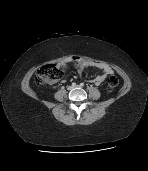File:Adrenal cortical carcinoma with IVC invasion and thrombosis (Radiopaedia 34307-35597 Axial C+ portal venous phase 56).jpg