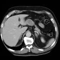 Adrenal hemangioma (Radiopaedia 11039-11445 Axial C+ portal venous phase 3).jpg