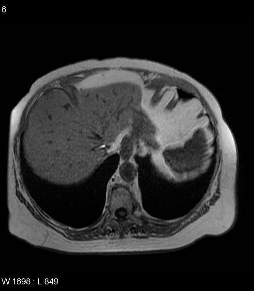 File:Adrenal myelolipoma (Radiopaedia 6765-7961 Axial T1 in-phase 6).jpg