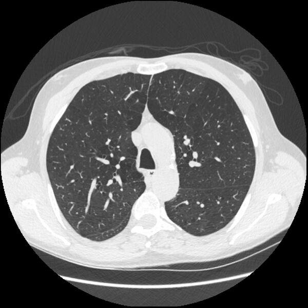 File:Alpha-1-antitrypsin deficiency (Radiopaedia 40993-43722 Axial lung window 75).jpg
