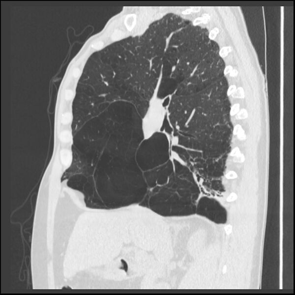 File:Alpha-1-antitrypsin deficiency (Radiopaedia 40993-43722 Sagittal lung window 162).jpg